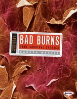 Bad_burns